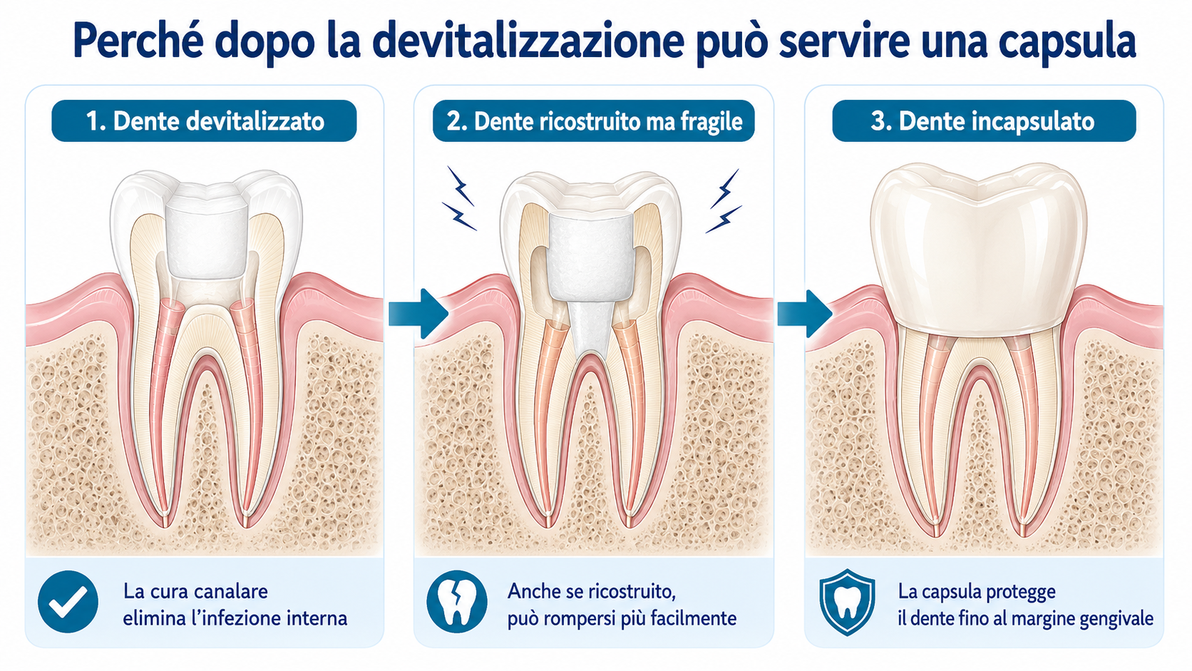 Schema in tre fasi: dente devitalizzato, dente ricostruito ma fragile e dente protetto da capsula fino al margine gengivale