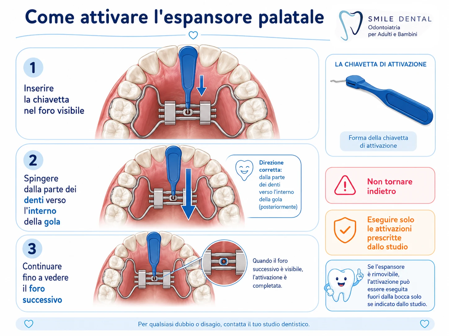 Attivazione dell’espansore palatale fisso