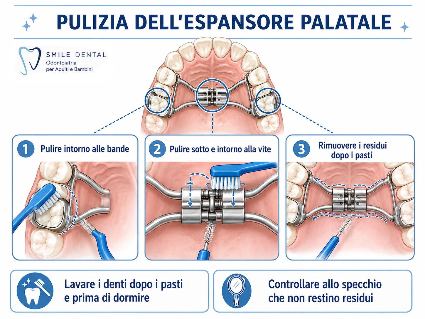 Pulizia dell’espansore palatale fisso