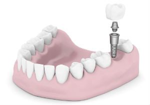 dentalimplants copy